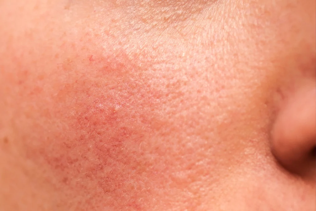 rosacea on the skin side effect of Folate